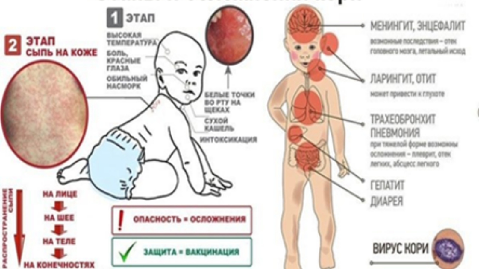 Вирусный минингитовая инфекция. Клинические проявления кори у детей. Коревая краснуха пятна. Корь основные клинические симптомы.